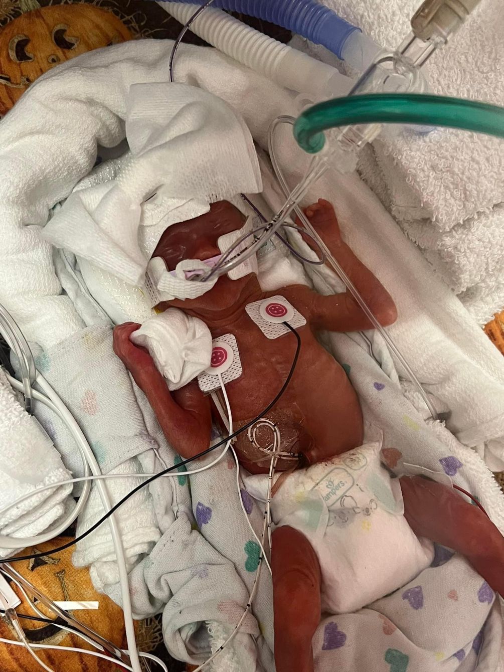 About the Fundraiser for Baby Addi & Luedeke family campaign on Bonfire 6